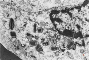 bone marrow - crystalloid inclusions Charcot-Leyden crystals formation bone marrow - crystalloid inclusions Charcot-Leyden crystals formation